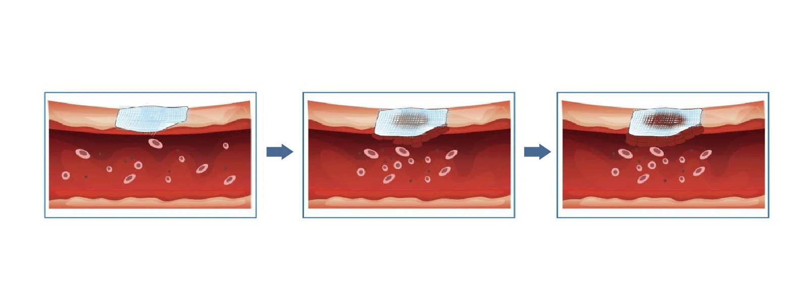 fibrillar-hemostat fibrillar-hemostat